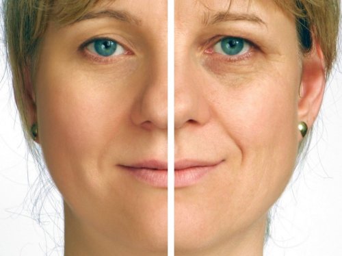 Skin Tightening with IPL